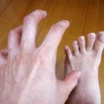 爪水虫(爪白癬)飲み薬 ラミシール VS イトリゾール 効果、副作用、飲み方