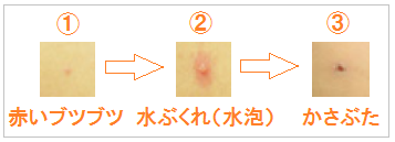 帯状疱疹の症状の経過の皮膚図面
