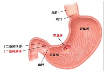 胃潰瘍と十二指腸潰瘍の起こりやすい場所